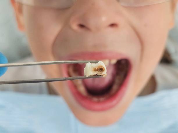 Best Emergency Tooth Extraction in Gahanna, OH
