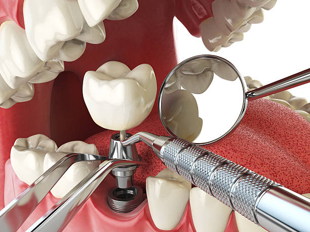 Best Emergency Broken Tooth Repair in Gahanna, OH